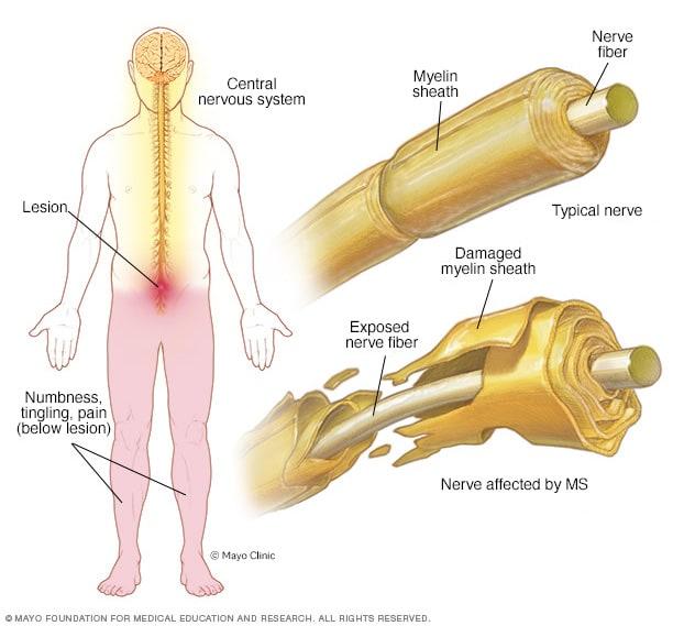 Understanding the Complex Landscape of Multiple Sclerosis