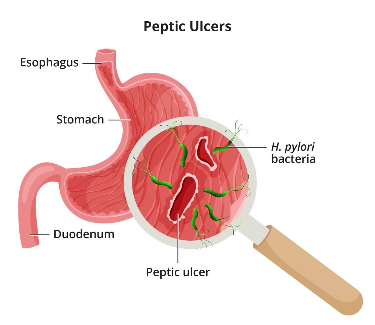 stomach ulcers