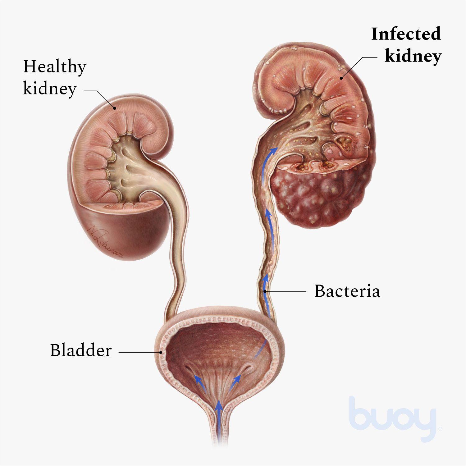 Understanding the Basics of ⁣Kidney Infections and Their ⁢Causes