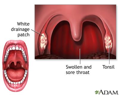 throat infection