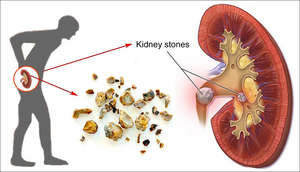 kidney stone treatment