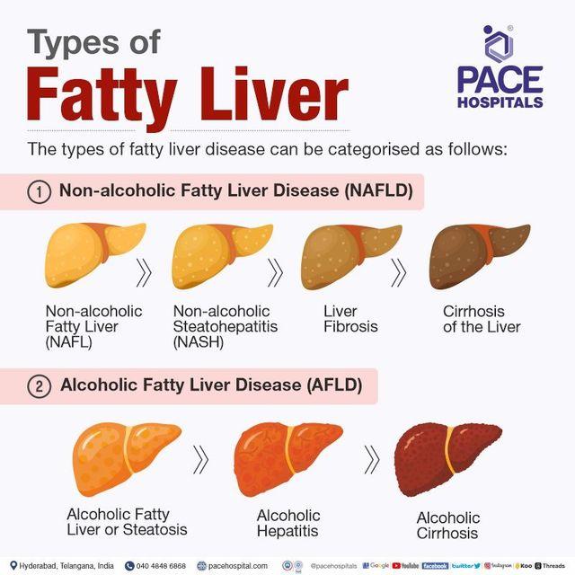 fatty liver