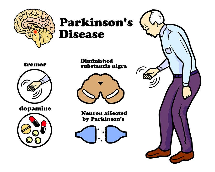 parkinson’s disease