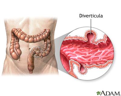 diverticulitis treatment