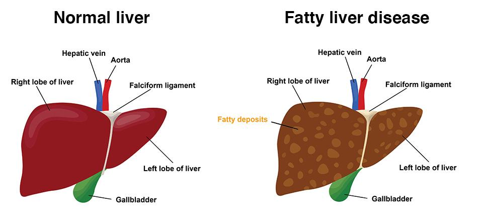 fatty liver disease