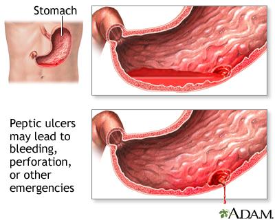 stomach ulcers