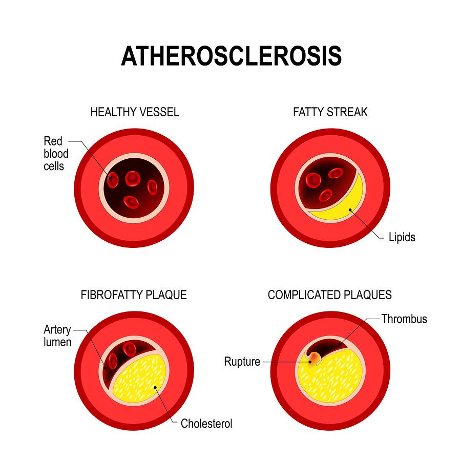 ldl cholesterol high