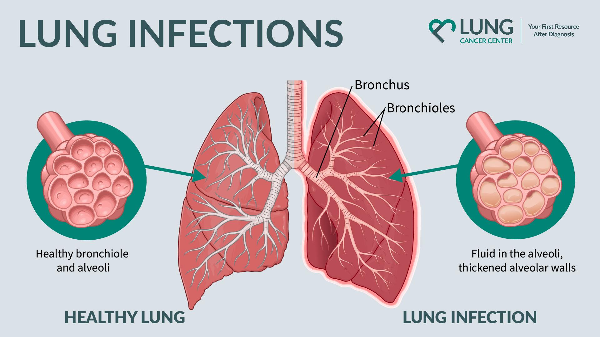 lung infection