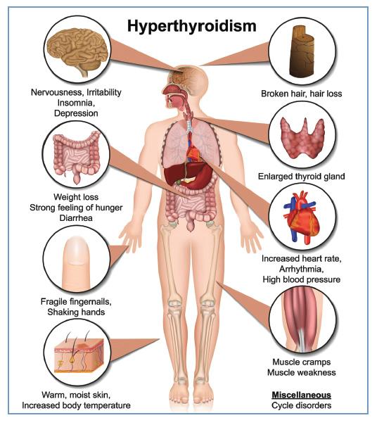 overactive thyroid