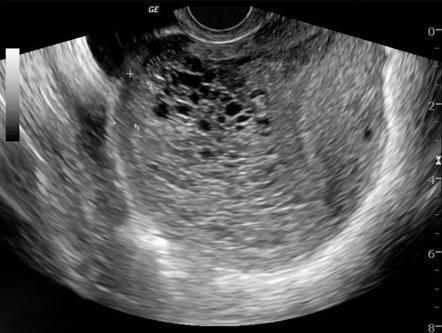 molar pregnancy