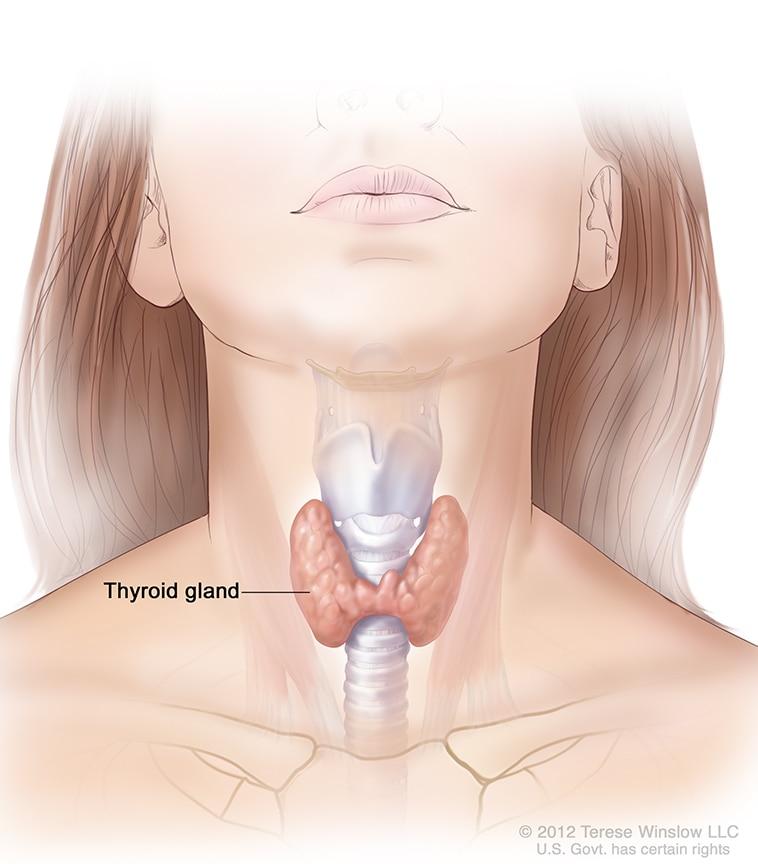 overactive thyroid