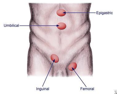 Understanding the Basics of ‌Hernias and Their Types