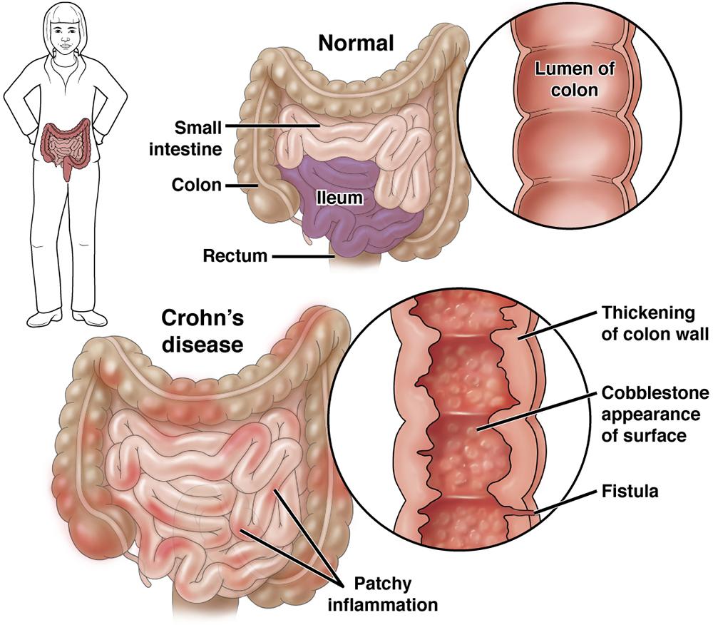 crohn’s disease diet