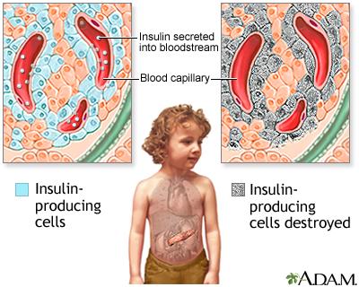 type 1 diabetes