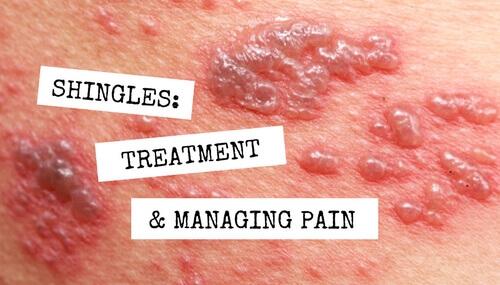 shingles treatment