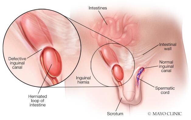 hernia