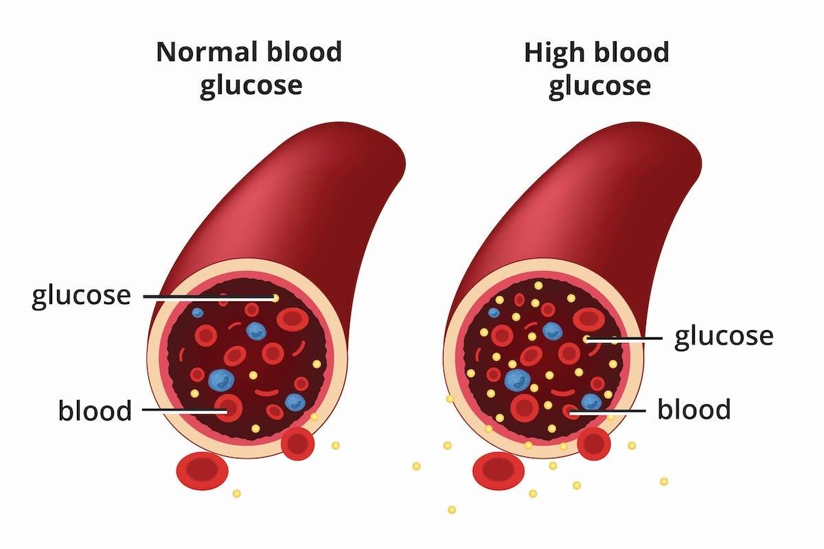 blood sugar