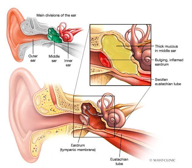 ear infection treatment