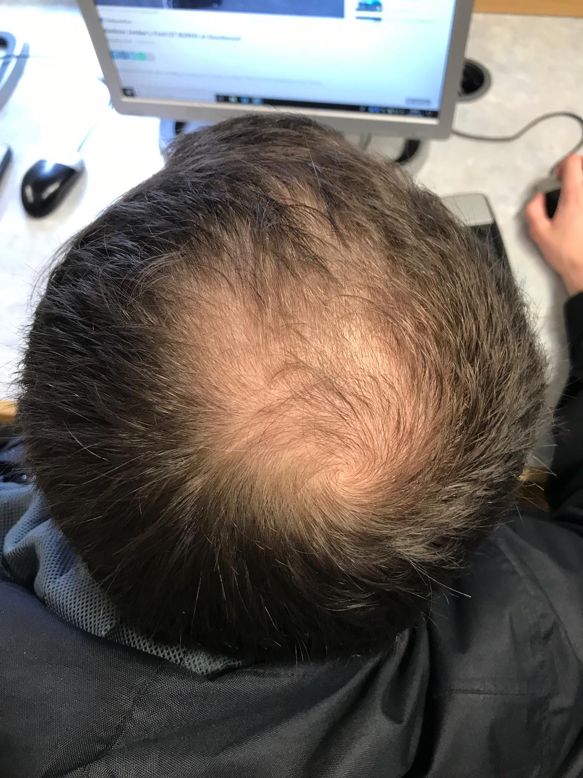 hair loss