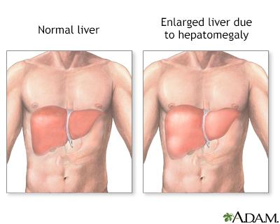 enlarged liver