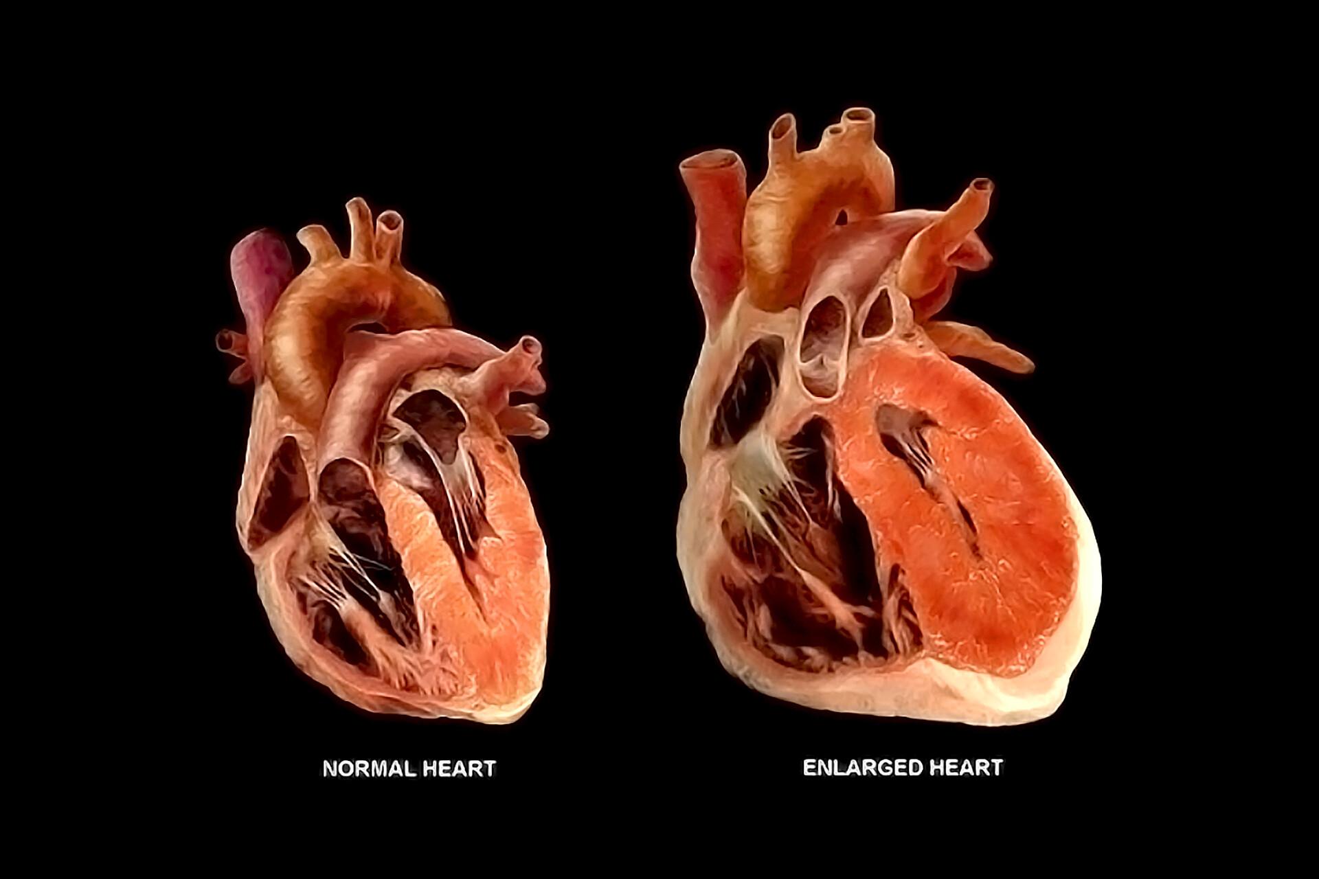 enlarged heart