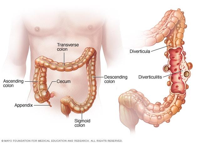 diverticulitis