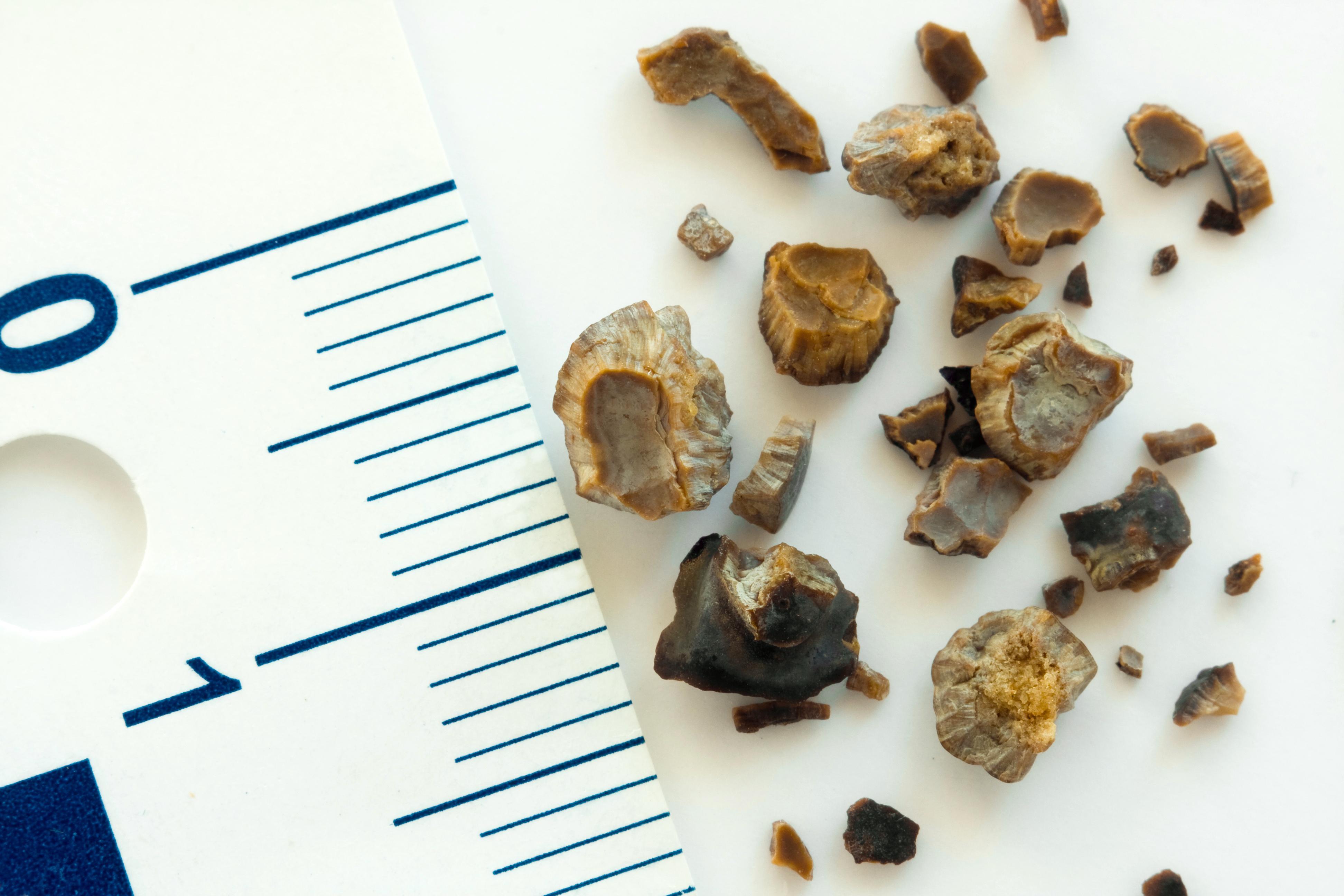 Understanding Kidney⁣ Stones and⁤ Their⁢ Types