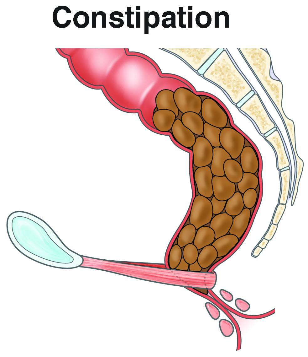 Understanding ⁣the Causes of Constipation and the Role ⁢of ‍Home Remedies