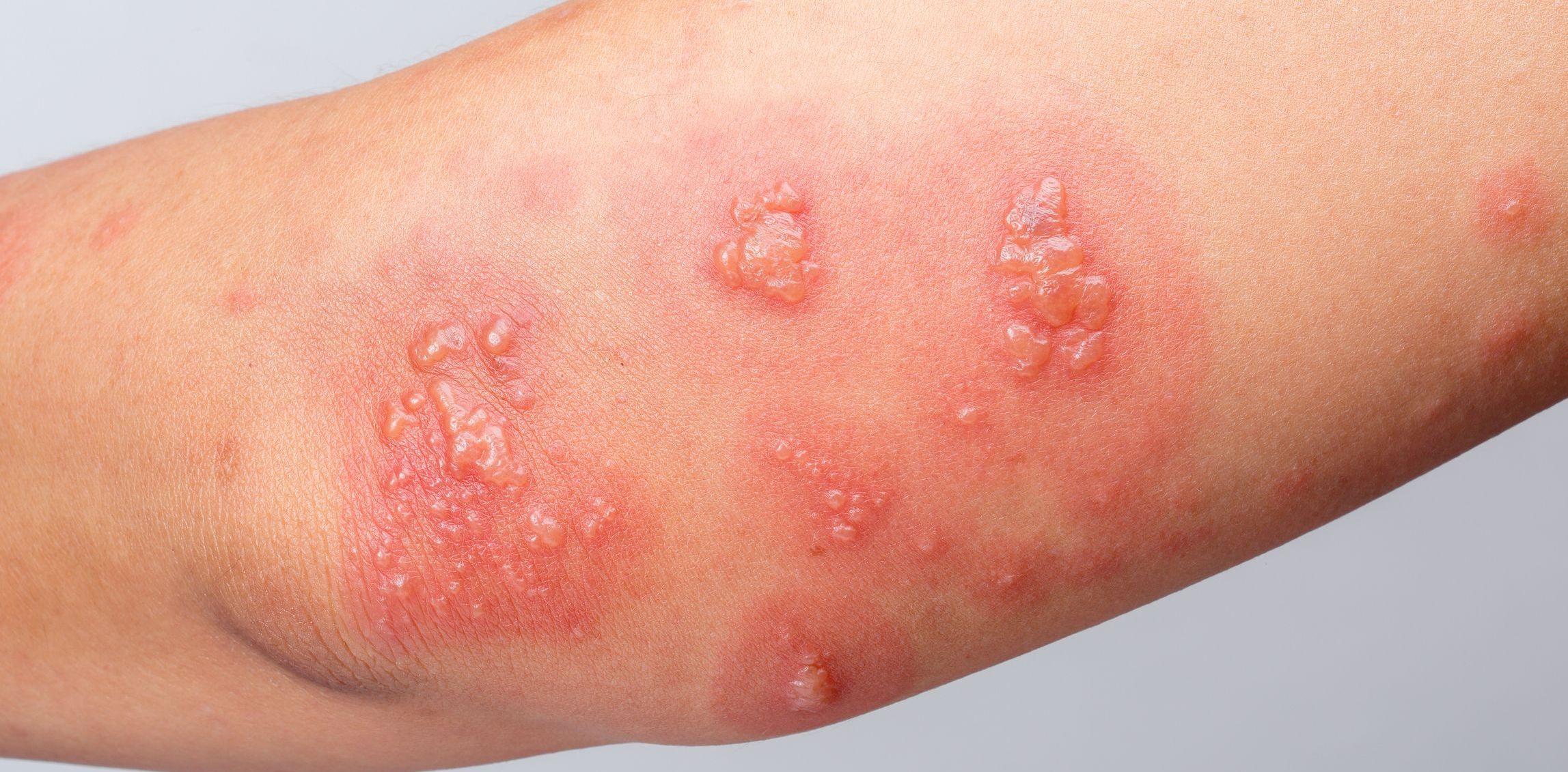 Understanding Skin​ Infections:‌ Causes and ⁣Types