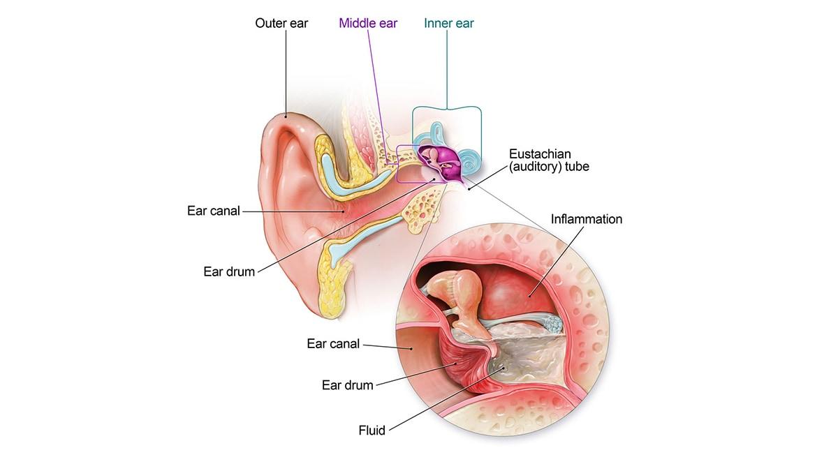 Understanding Ear Infections​ and ​Their Causes