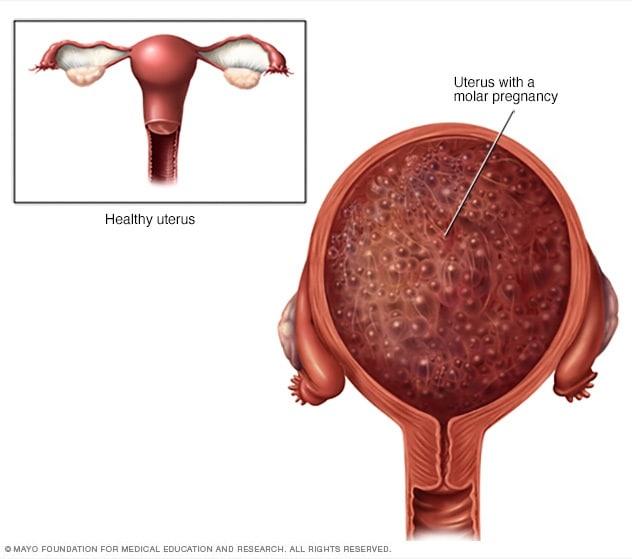 molar pregnancy