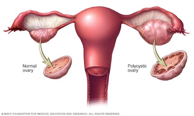 Understanding PCOS and ‍Its Nutritional Needs