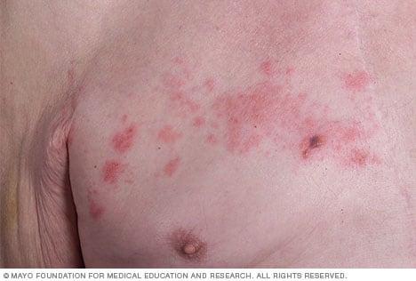 Understanding Shingles ​and Its Symptoms