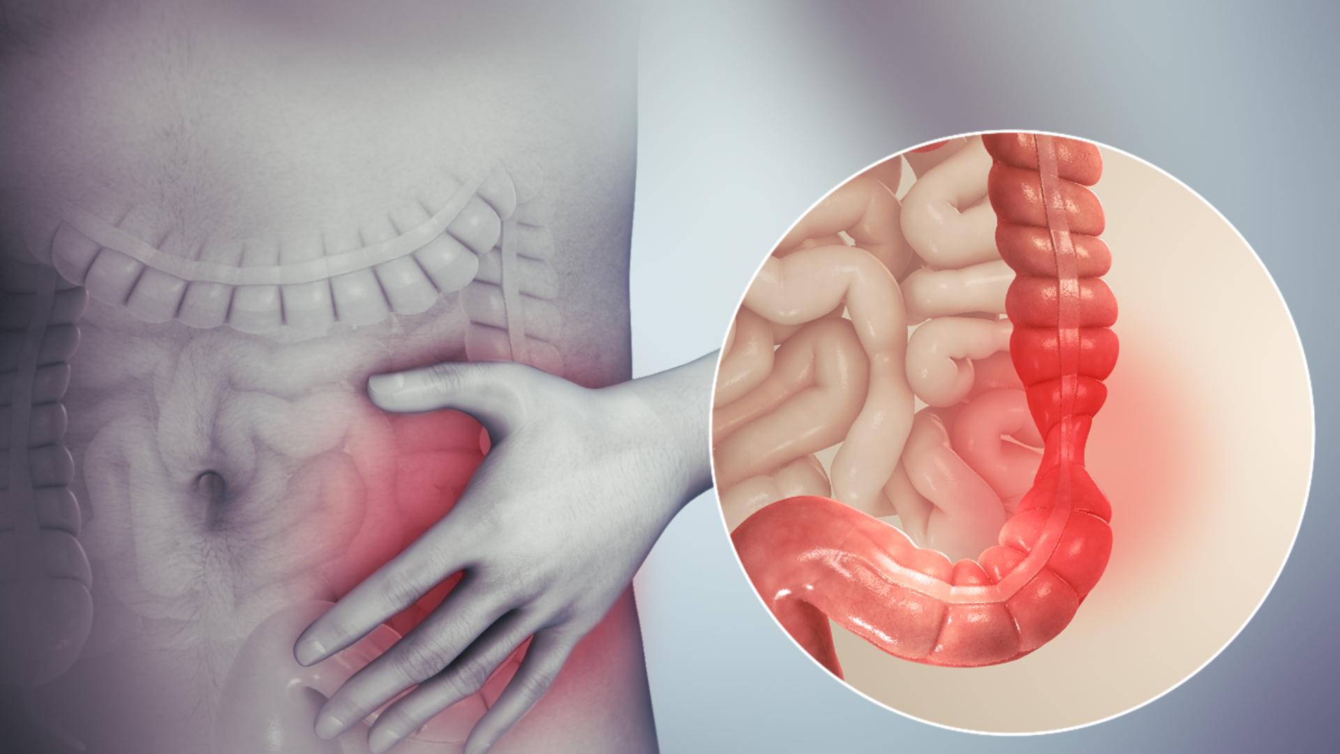 Understanding Irritable Bowel Syndrome and Its Impact on Daily Life