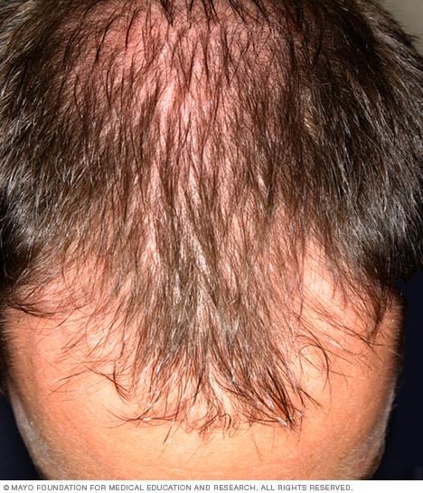 Understanding the ​Science Behind Hair Loss⁢ and Its Causes