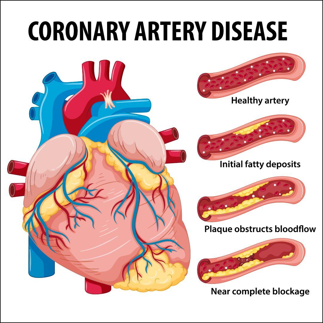 Understanding the​ Basics​ of‌ Coronary⁣ Artery Disease and Its Risk Factors