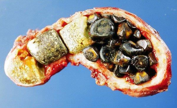 gallstones